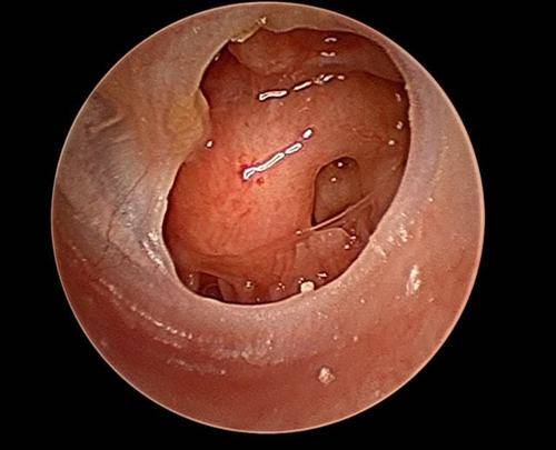 左耳鼓膜图片图片