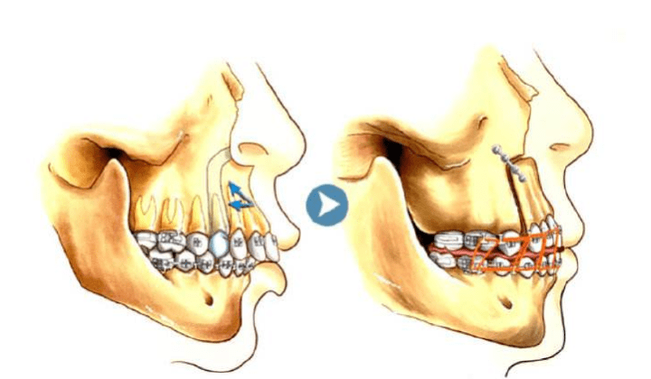 从而控制一定的手术风险,正颌手术则是解决正畸手术所无法达成的骨性