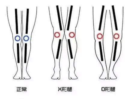 腿型不好看?想要改善怎麼辦