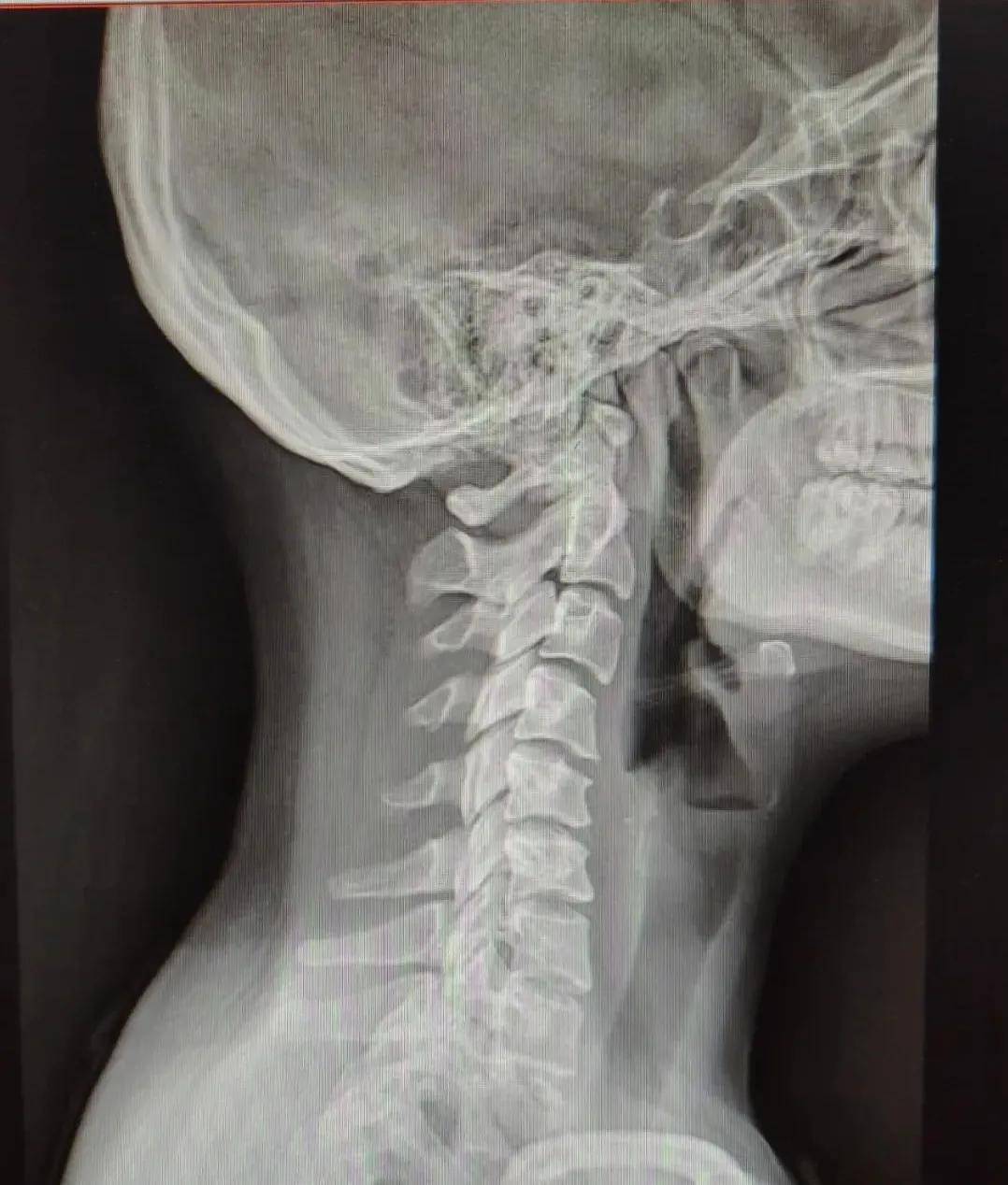 关节|影像检查｜DR&amp; CT&amp; MRI，在椎间盘疾病中如何选择呢？