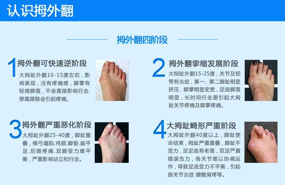 北京长峰拇外翻马文洲:拇外翻的症状是什么样的_治疗_关节_畸形