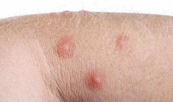 什么原因会引起淋巴结肿大 78451b0083c6400d967875ddb876c1be.jpeg