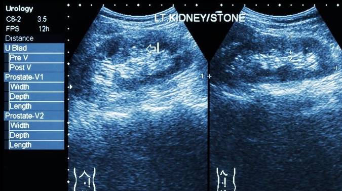 关键|得了肾结石,管住嘴是关键:少吃2类食物,防止结石变大