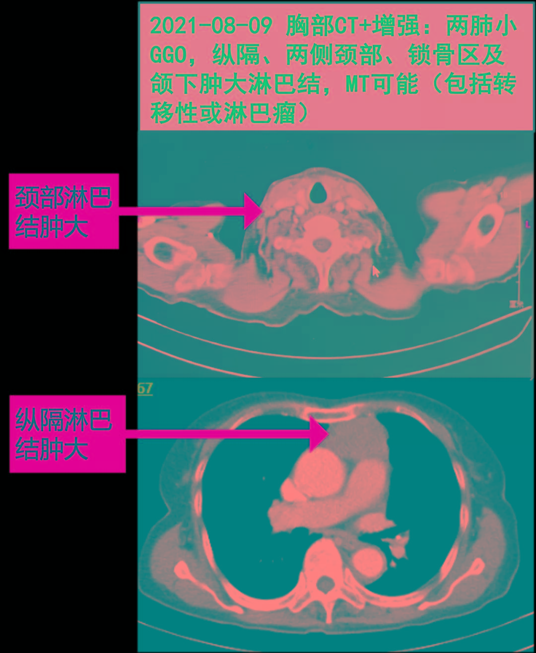 mt可能(包括轉移性或淋巴瘤);病理科會診外院淋巴結穿刺病理片,切片1