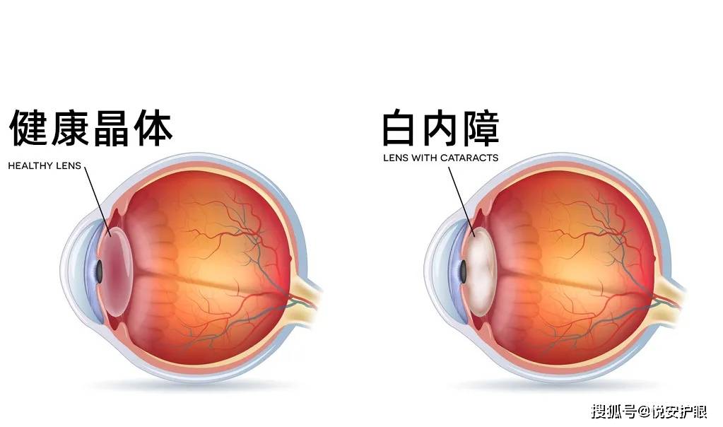 悅安護眼提醒小心居然這麼多眼病會遺傳給下一代