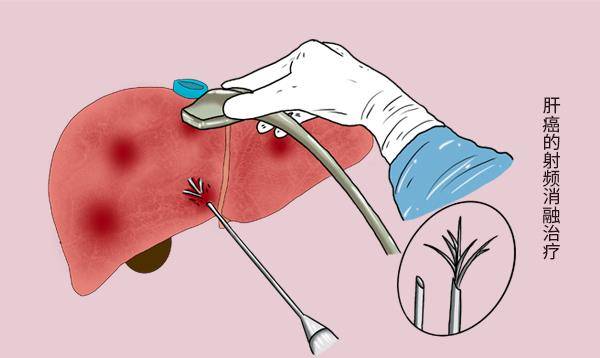 癌变|从乙肝发展成为肝癌,需要多长时间?做好三级预防,保护肝脏安全