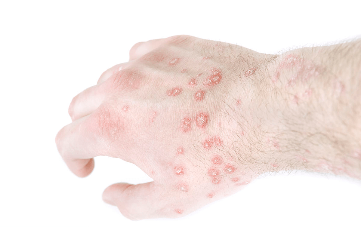 湿疹和皮炎的区别有哪些湿疹是什么皮炎是什么
