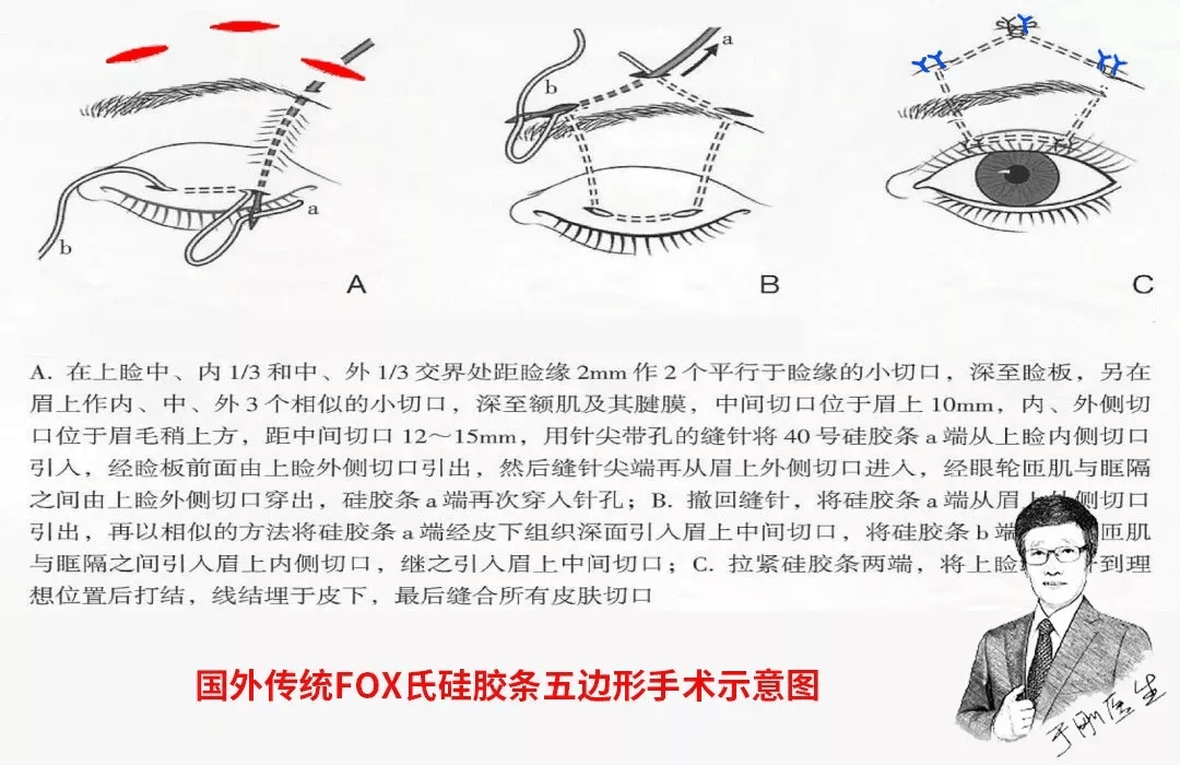 手术|五年八部曲，上睑下垂分阶段治疗的故事
