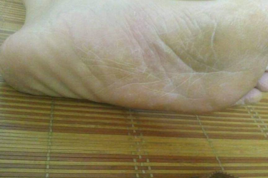 肝脏|肝好不好，看脚就知道，若没有这些变化，说明肝很干净