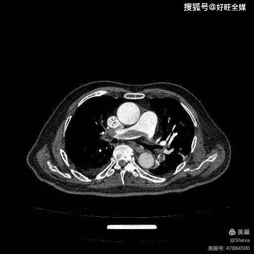 腎動脈cta胸部ct平掃-胸主動脈夾層動脈瘤ct引導下穿刺活檢踝關節x線