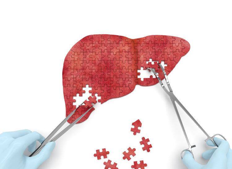 症状|得了肝硬化还能活多久?服从三个方法治疗,或许寿命与正常人无异