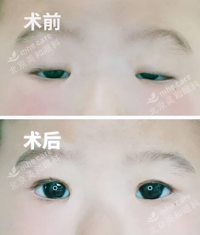 五年八部曲,上睑下垂分阶段治疗的故事_可乐_妈妈_于刚