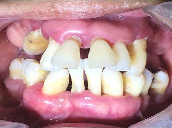 如果长期大力横向刷牙,导致牙颈部出现缺口,使牙本质暴露,就会引起