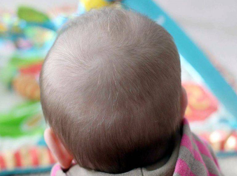 1岁宝宝头发稀少照片图片