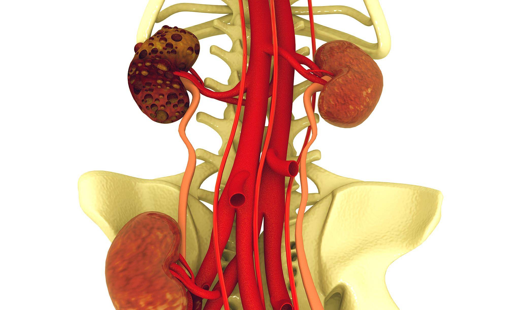 治疗|得了尿毒症，该如何来治疗？希望你别轻易放弃