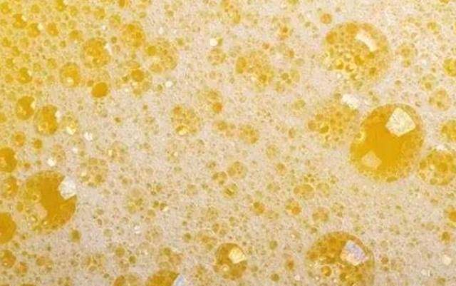 毒素|肾脏衰竭前,往往会有几个征兆,可能被多人忽视