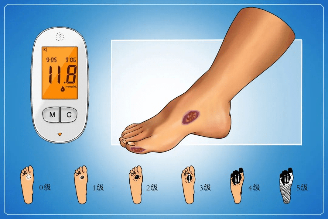 饮食|糖尿病人饮食的8个误区，做好并发症日常预防