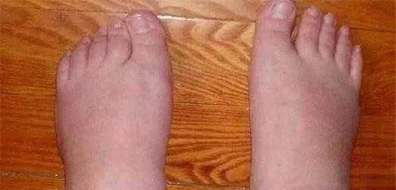 尿酸|尿酸超标的人，若身体出现3种“变化”，或许是肾衰竭找上门