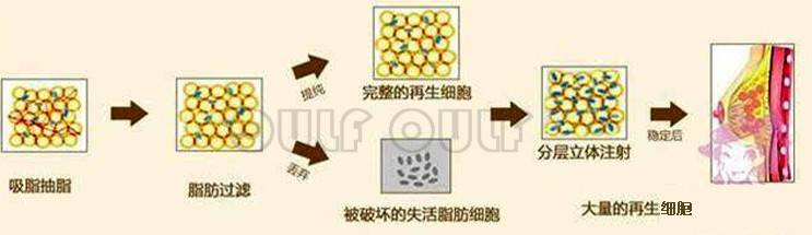 能量脂肪填充眼窝多久恢复自然？脂肪填充眼窝一年后图片惊呆了前男友~