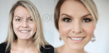 部位求证!全脸脂肪填充到底好不好,全脸脂肪填充大脸咋回事~