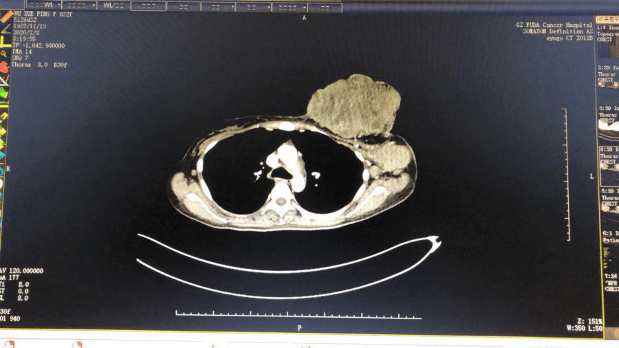 化疗|上海肿瘤医院请选择广州复大肿瘤医院：救治巨大乳腺癌患者