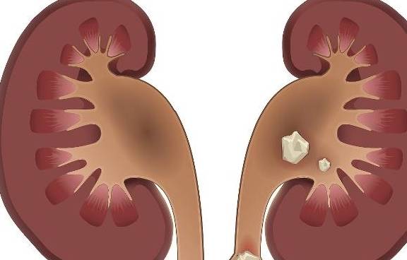 肾脏|有肾结石的人，这5类食物最好“忌口”，吃多了容易加重病情