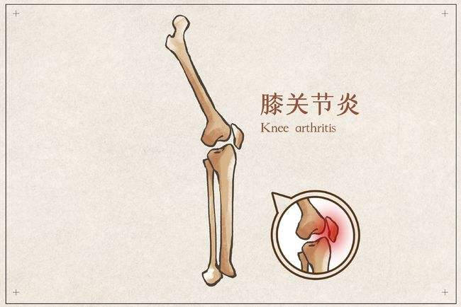 患了关节炎怎么办