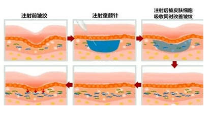 白天“再生医美”热度不减，精通TA的咨询师都年入百万了....