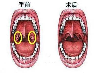 成都民生耳鼻喉医院好吗 喉咙肿痛怎么办_扁桃体_免疫_手术