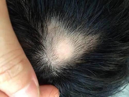辉瑞新脱发药物litfulo获fda批准可恢复脱发患者80的毛发 字节点击