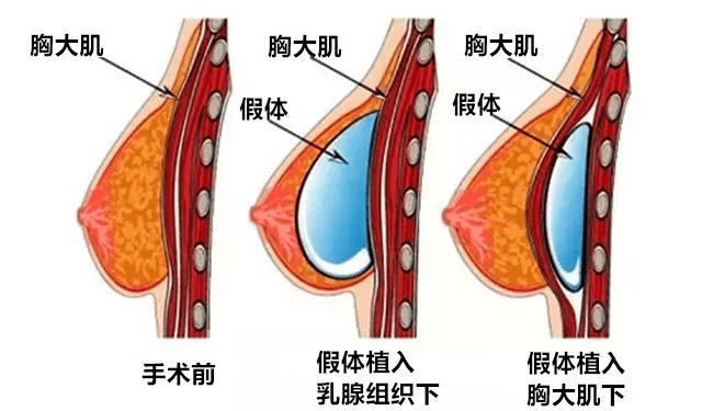 乳房济南韩氏张鑫萌医生讲解假体隆胸的并发症