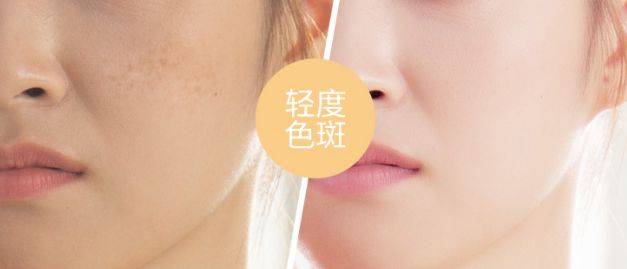 人群黛维依祛斑是真的_想要去掉脸上的斑,好用又少折腾的办法分享给你