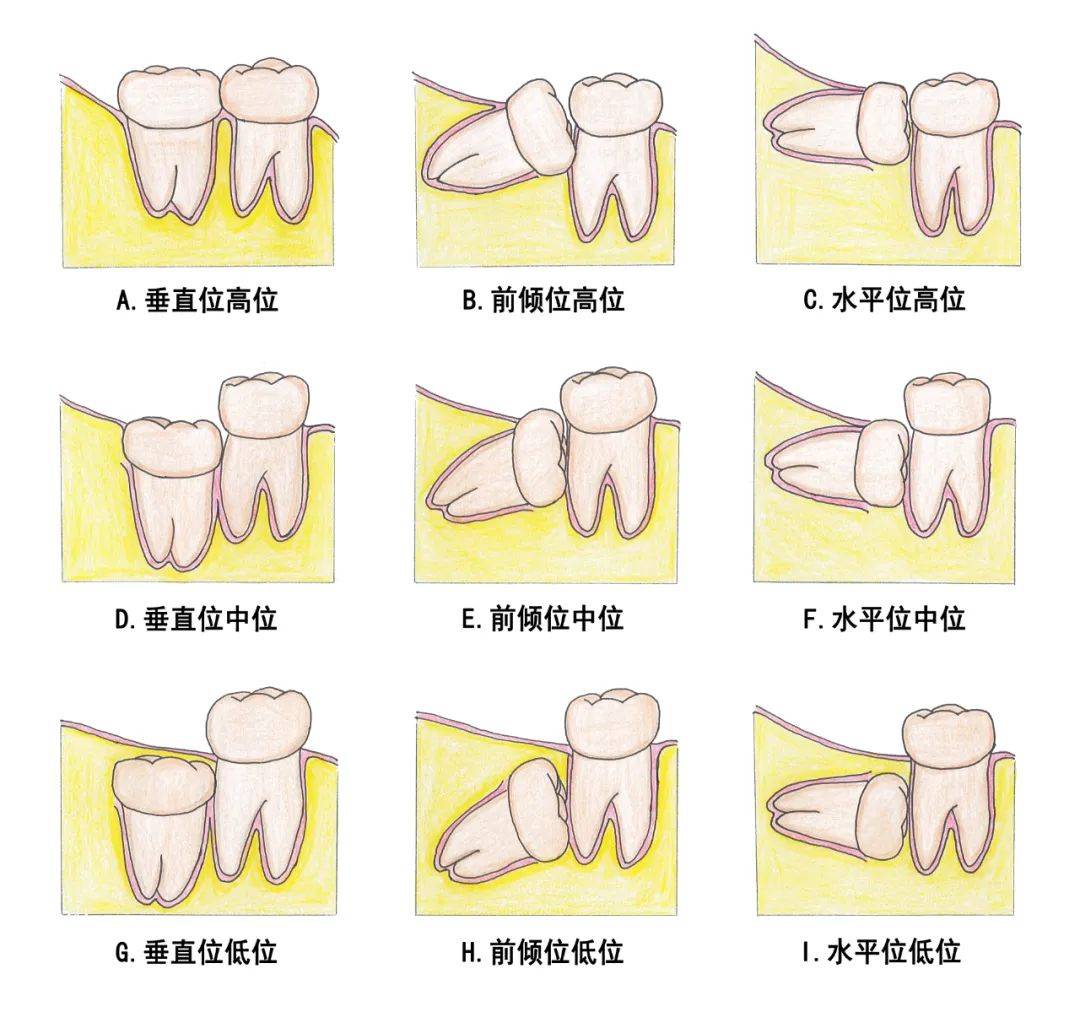 智齒髮炎為何不能立刻拔