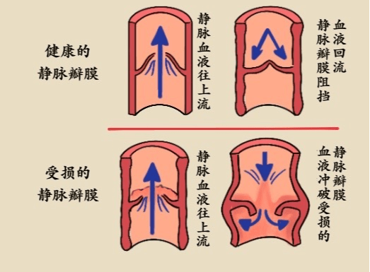 下肢静脉瓣膜位置图片图片