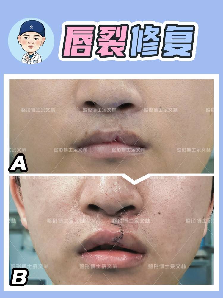 科普唇裂术后人中形态不好看要怎么修复