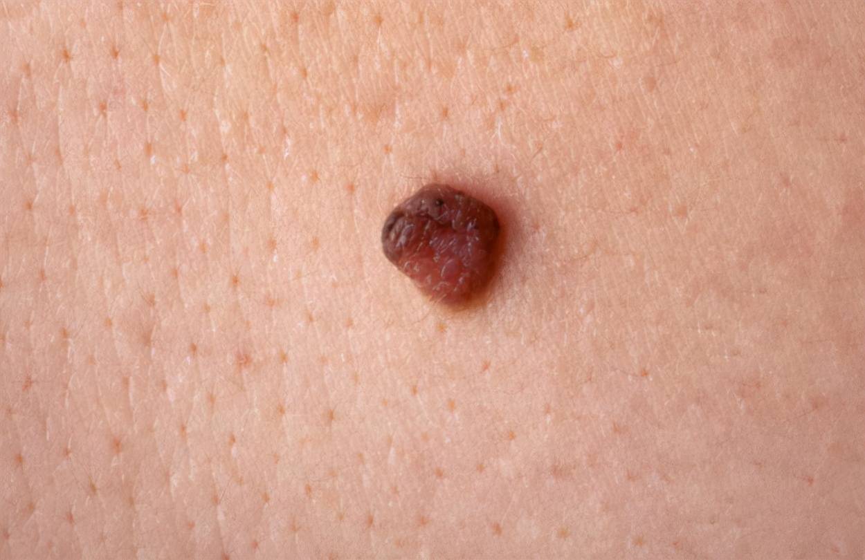 hpv大腿上红点鸡皮肤(hpv会引起大腿内侧瘙痒起红斑吗)