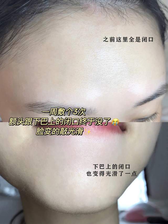 周干刷酸可以去痘痘、闭口、黑头？水杨酸棉片保姆级试用教程