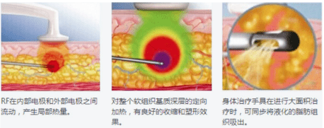 什么黄金微雕和线雕有什么区别？法令纹做线雕效果怎么样？