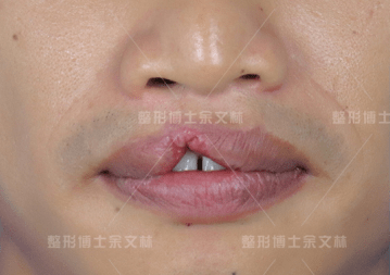 成形术唇裂继发红唇畸形修复，要恢复正常的形态容易吗？