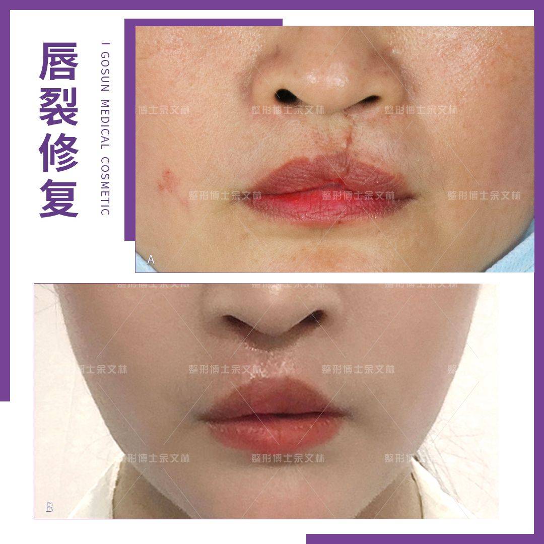 成形术唇裂继发红唇畸形修复，要恢复正常的形态容易吗？