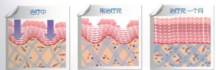 玛吉解疑：做一次热玛吉价格是多少？美容项目热玛吉价格多少？内幕来了~