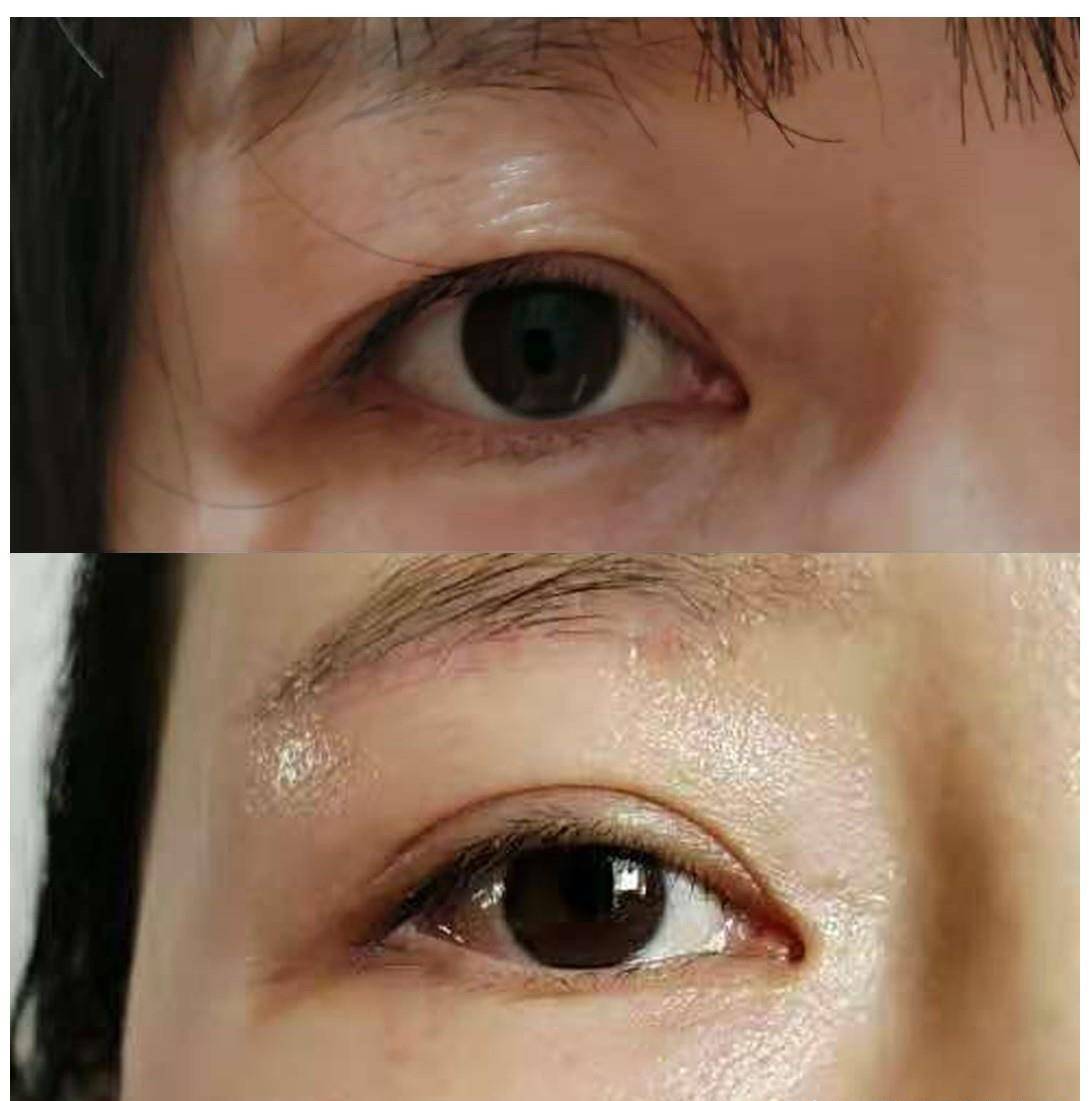整形作为做过“提眉手术”的人，我来说几点真实的感受