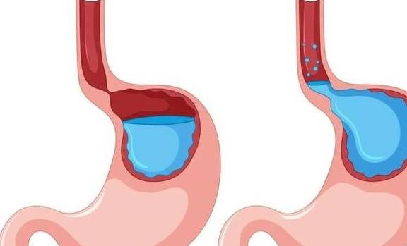 是什么原因引起胃食管反流 96e642b696e34af89cc56743535cff19.jpeg