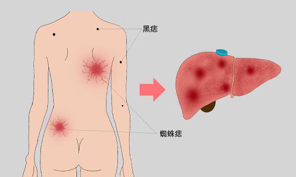 肝脏|皮肤上长痣，预示肝脏病变？若伴随身体异常表现，尽早检查肝功能