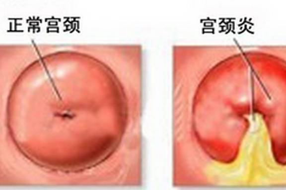 急性阑尾炎是什么原因导致的 78fa2a27bc434390abf35b806699f2ed.jpeg