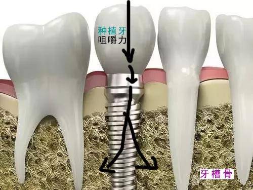 牙没了想补牙,选烤瓷牙还是种植牙?