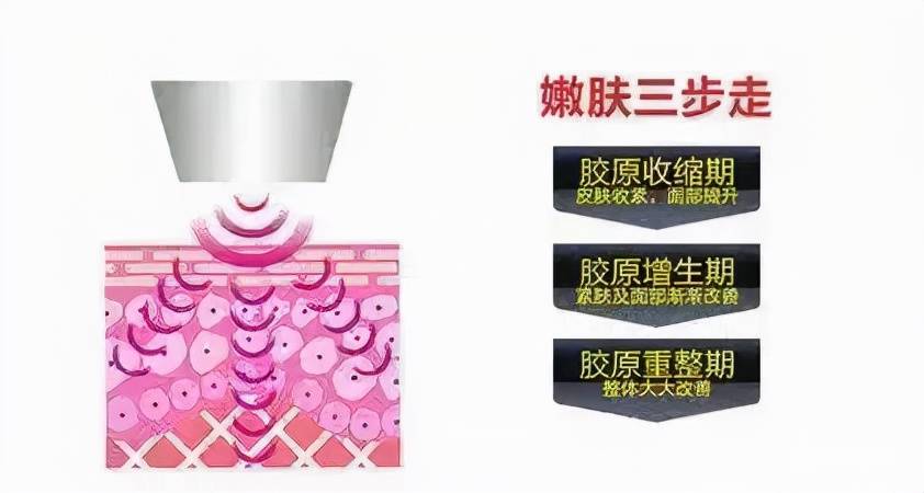 治疗美肤医师郭金月：想要皮肤水嫩，该选择光子嫩肤还是水光？
