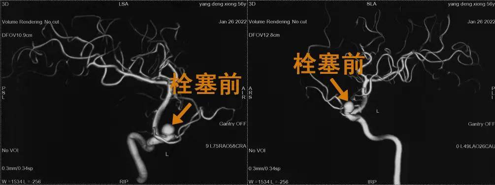 血管|头晕欲裂揪出颅内动脉瘤 医生极限“拆弹”化险为夷