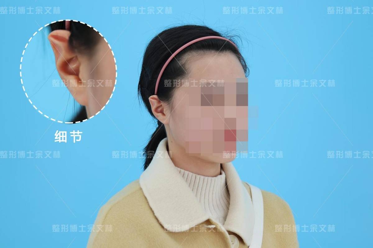 耳朵畸形手术吗_畸形耳朵手术医院_畸形耳朵手术后会痛苦多久呢