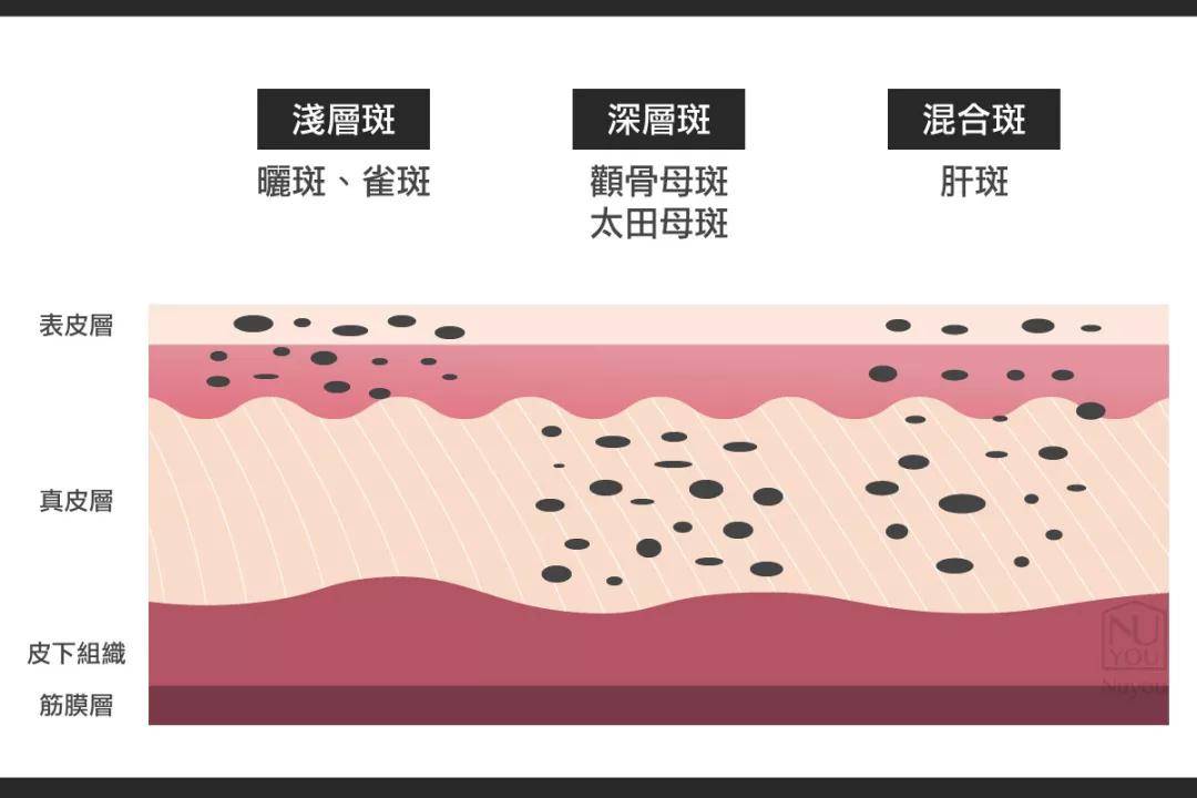 脸颊奶酷少年脸成高奢新宠模特？多亏了她满脸的雀斑…